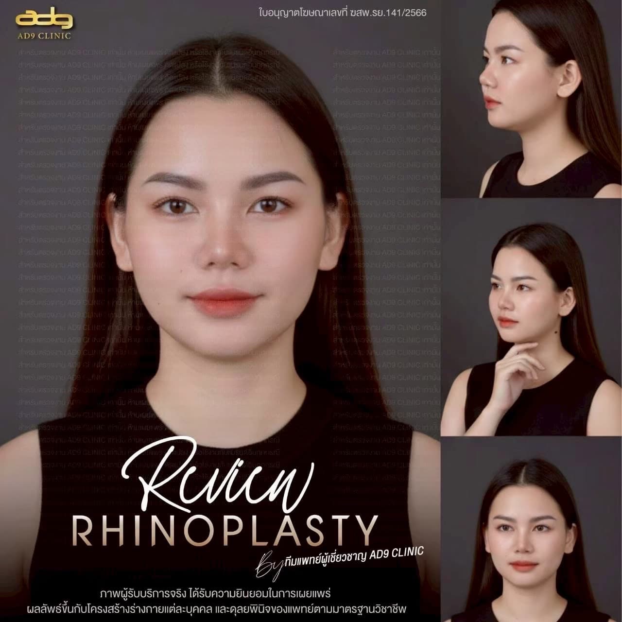 ภาพรีวิวเสริมจมูก 3 มุมมอง AD9 Clinic