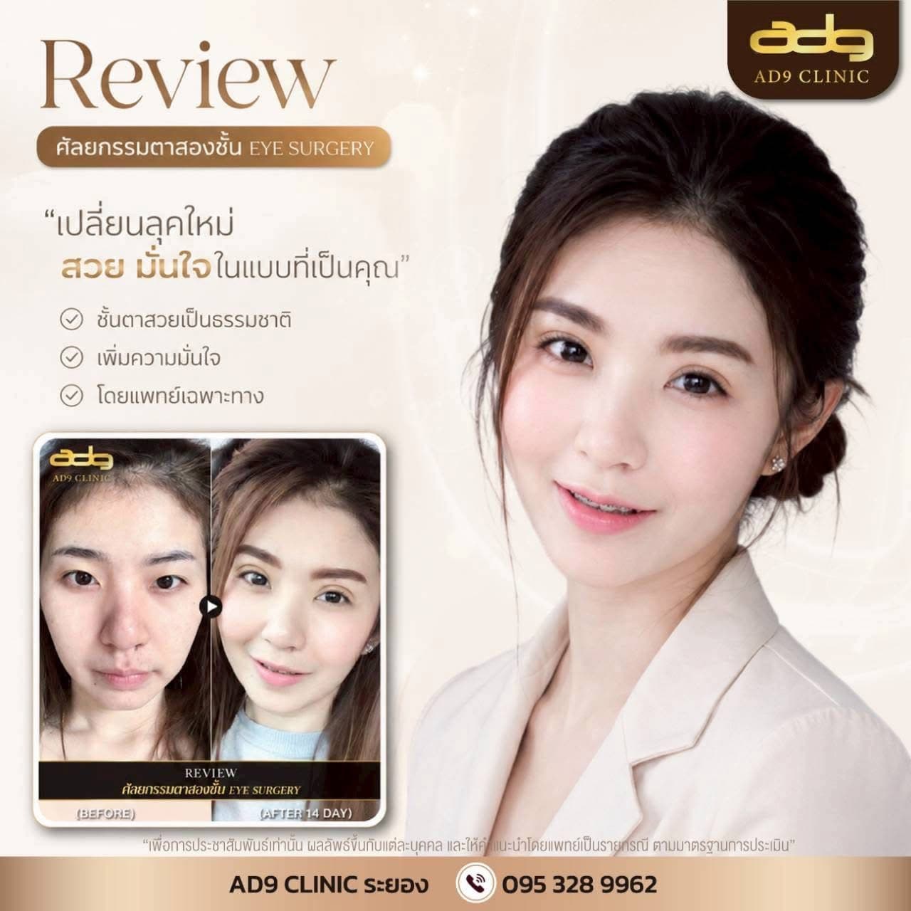 ภาพรีวิวศัลยกรรมตาสองชั้นจากผู้รับบริการจริง AD9 Clinic ระยอง