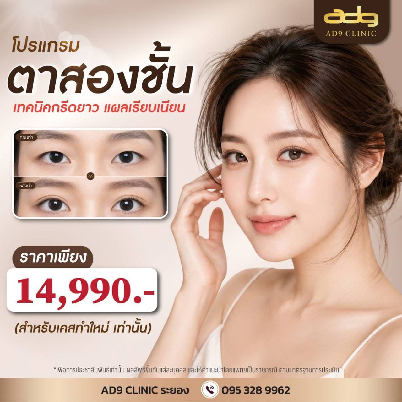 ภาพรีวิวผลงานตาสองชั้น เทคนิคกรีดยาว แผลเรียบเนียน AD9 Clinic