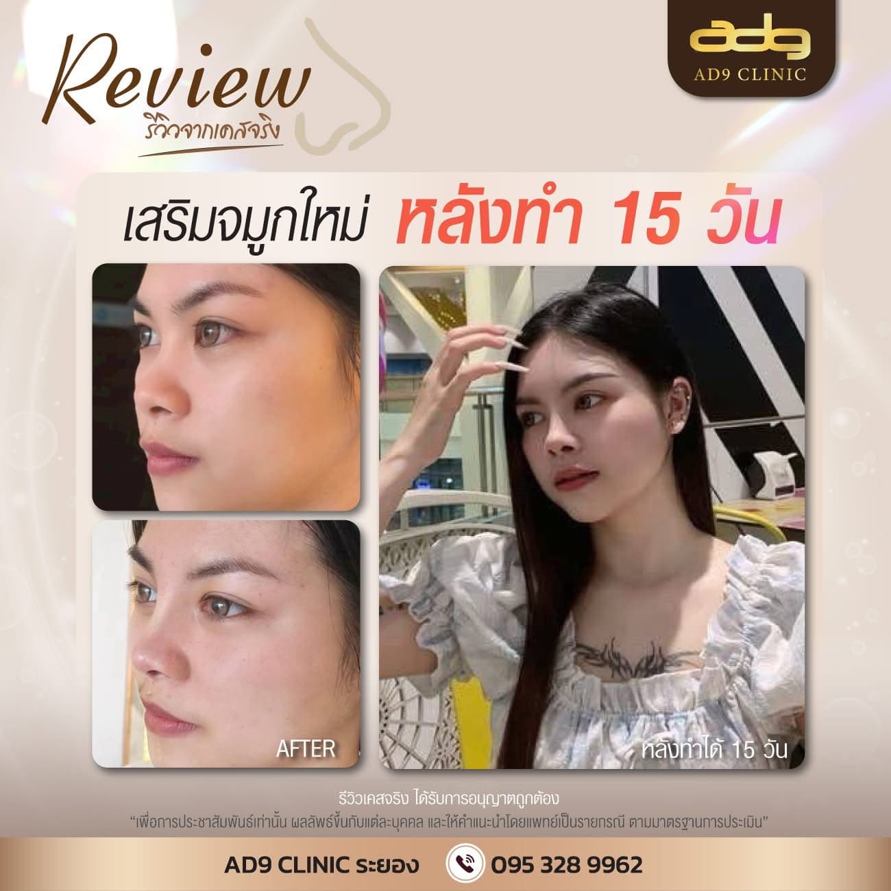 ภาพรีวิวเสริมจมูกใหม่ หลังทำ 15 วัน AD9 Clinic