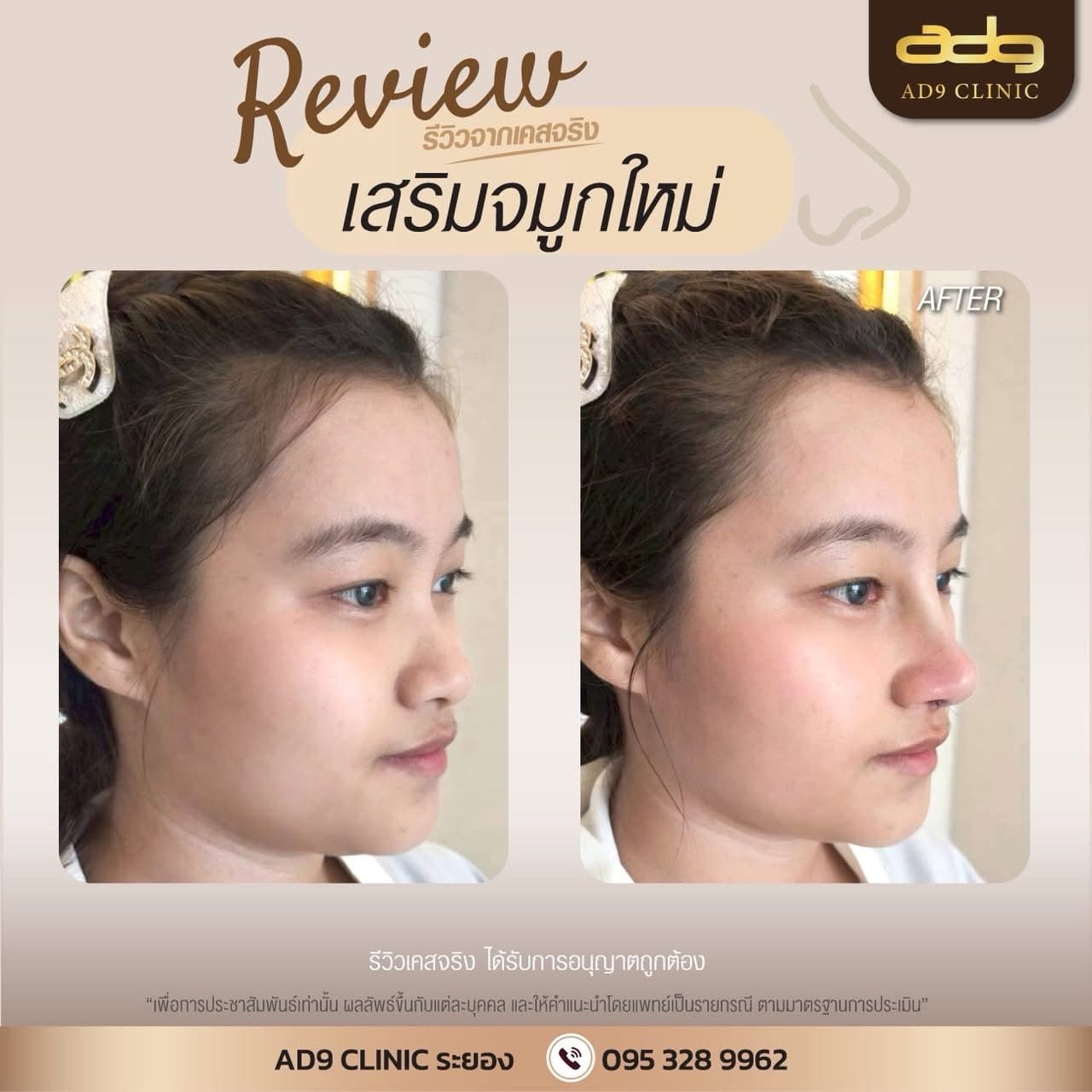 ภาพเปรียบเทียบเคสเสริมจมูกใหม่ ก่อนและหลังทำ AD9 Clinic