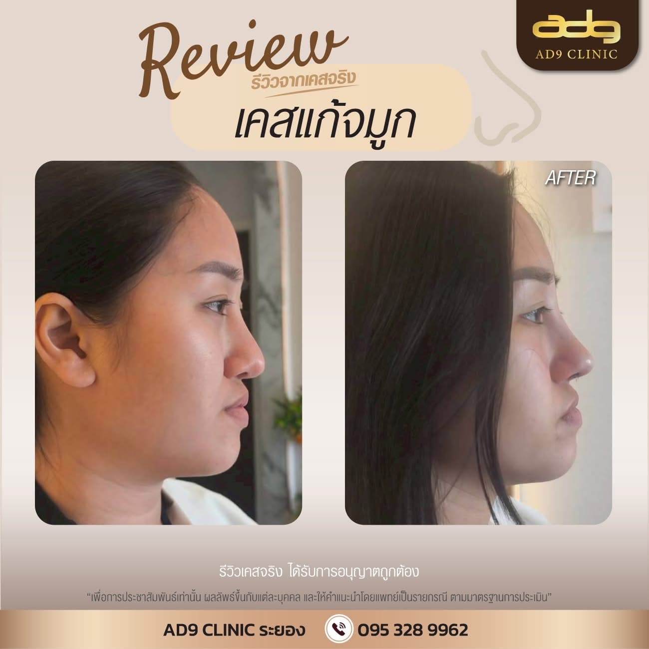 ภาพรีวิวเคสแก้จมูก ปรับโครงสร้าง AD9 Clinic